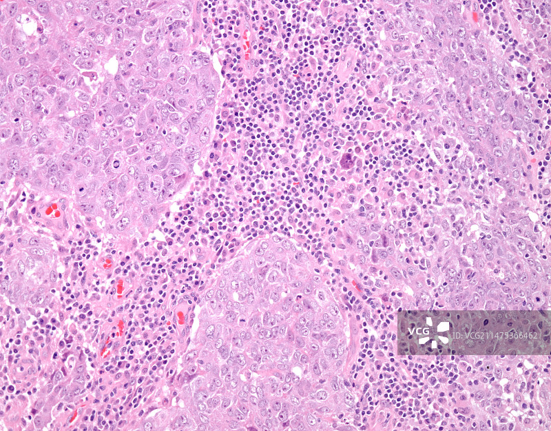 高级别浸润性导管乳腺癌，光学显微镜照片图片素材