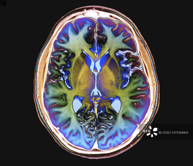 人脑轴向MRI扫描图片素材