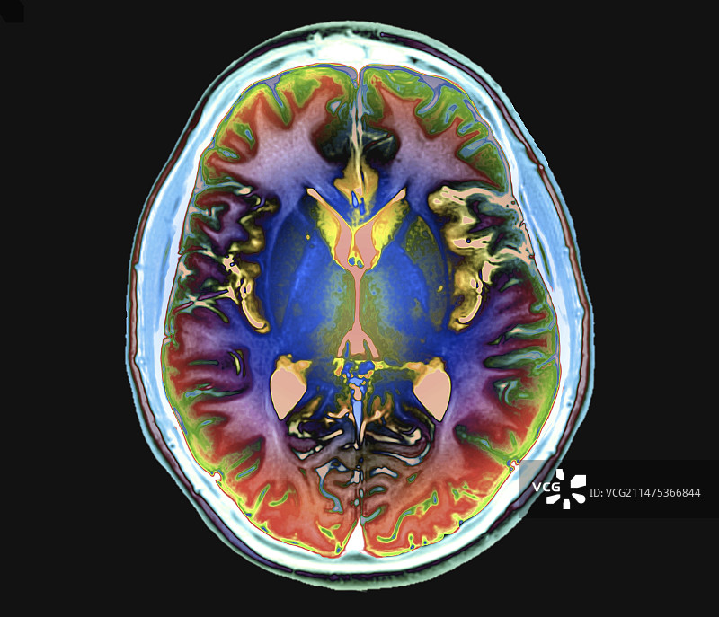 人脑轴向MRI扫描图片素材