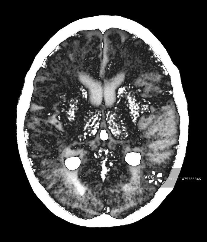 中风脑损伤CT扫描图片素材