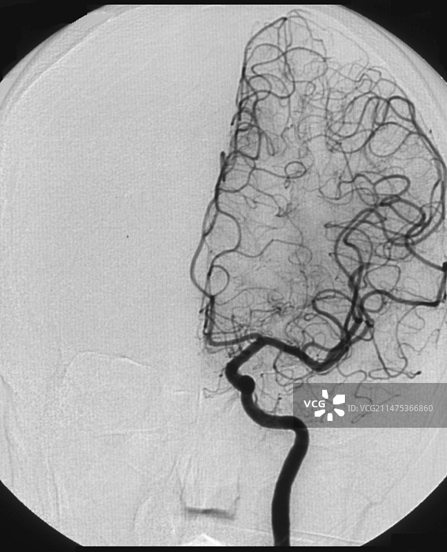 中风治疗后的脑动脉血管造影图片素材