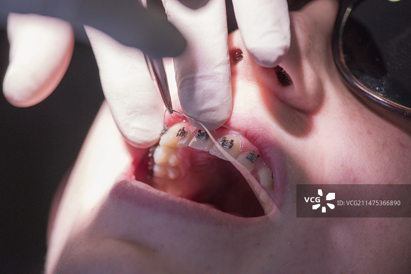男孩接受牙齿矫正图片素材