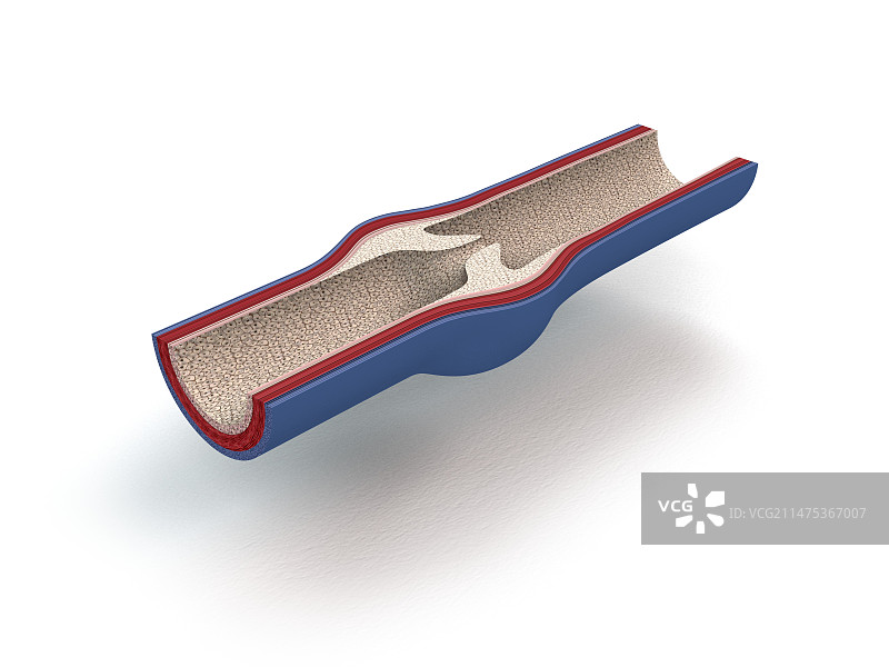 静脉瓣膜插图图片素材