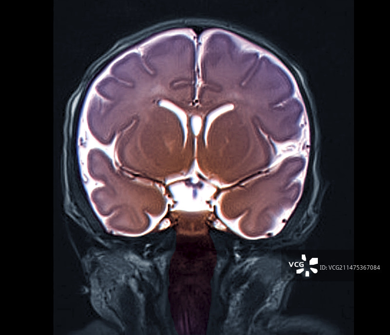 脑室异常核磁共振扫描图片素材