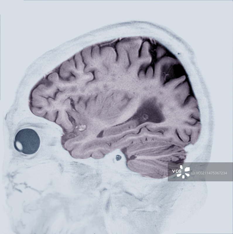 阿尔茨海默病MRI脑部扫描图片素材