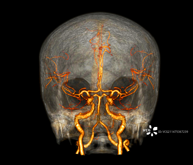 脑部和颈动脉3D血管造影图片素材