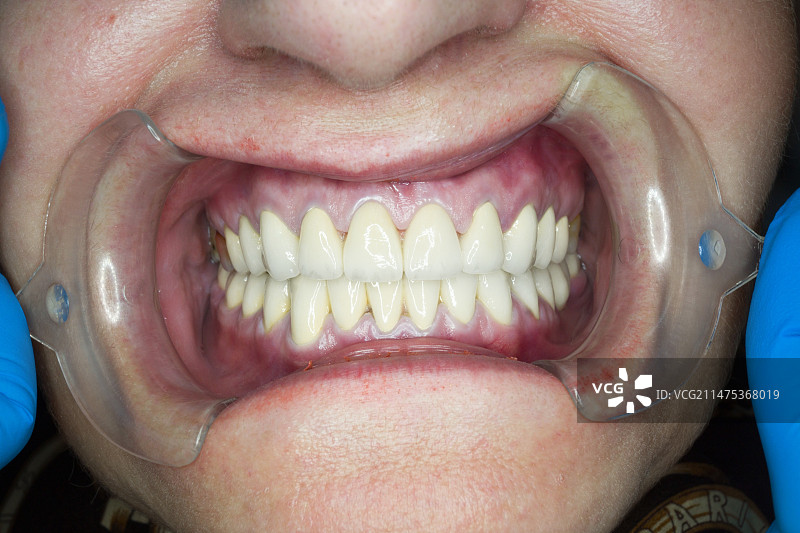 牙冠手术后的牙齿图片素材