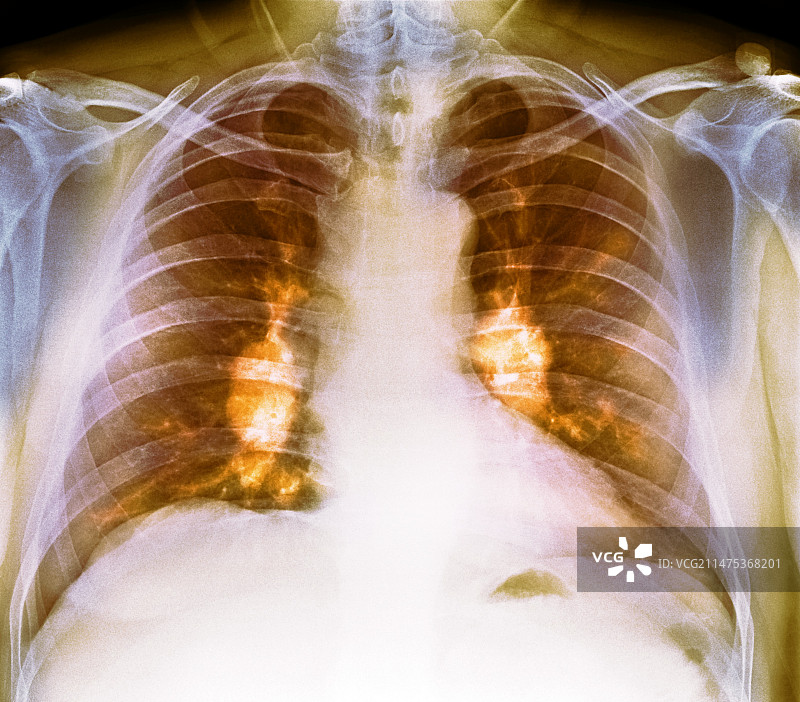 肺部结节病X光片图片素材