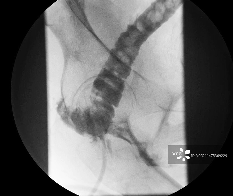 直肠阴道瘘X光片图片素材