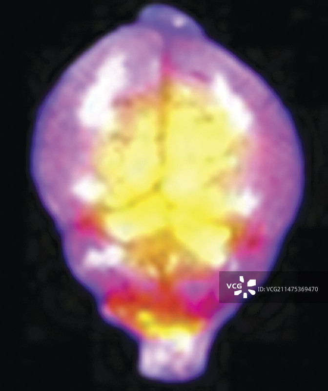 作为实验性脑癌治疗的纳米颗粒图片素材