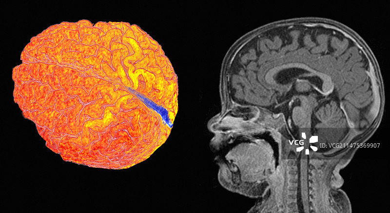 孩子的大脑和头部，3D及正中矢状位MRI扫描图片素材