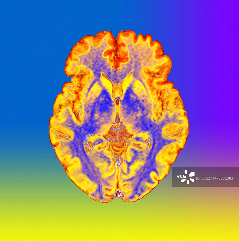 人脑轴向MRI扫描图片素材