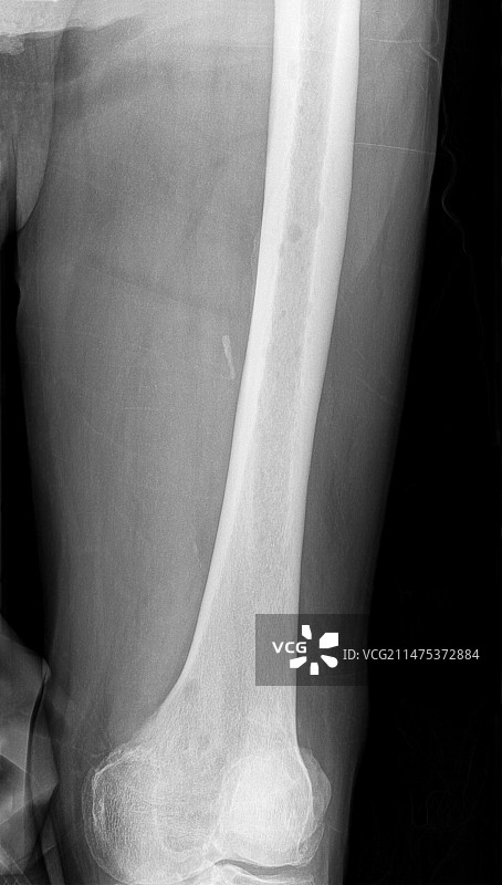 骨髓瘤骨扫描X光片图片素材