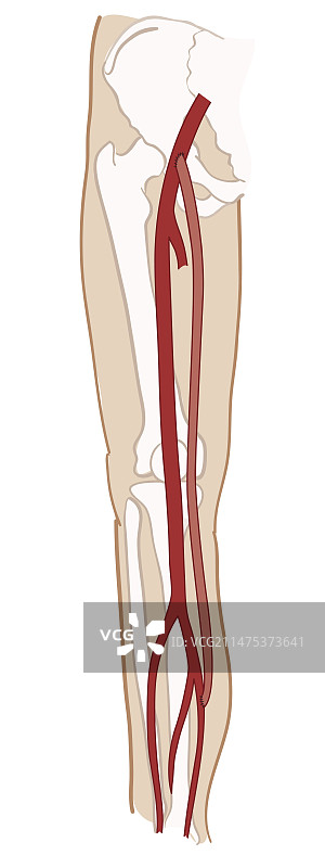 腿部股腘动脉旁路移植术，图示图片素材