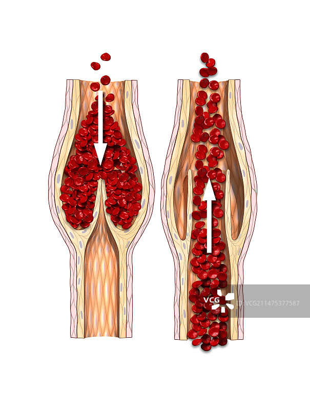 血管中的阀门机制插图图片素材