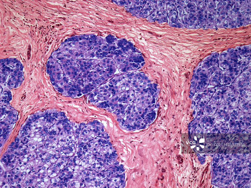 肝癌，光学显微镜照片图片素材