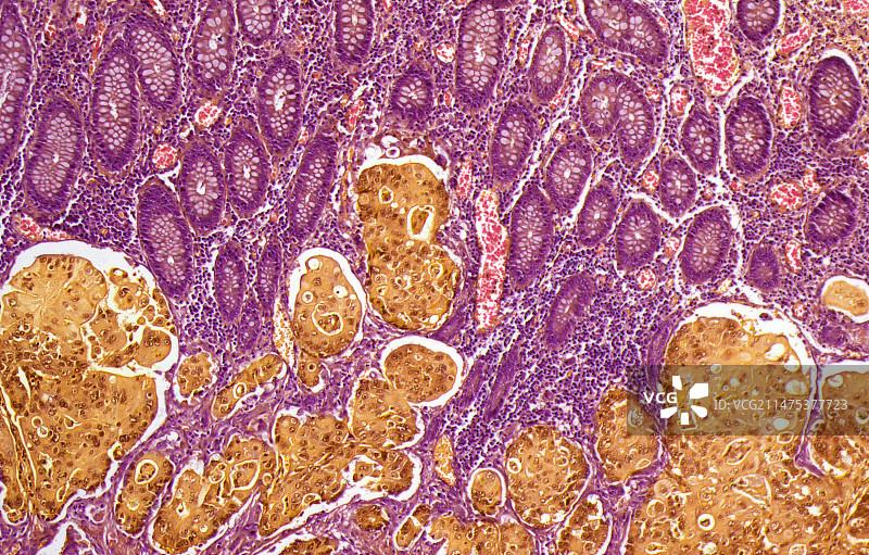 结肠癌显微照片图片素材