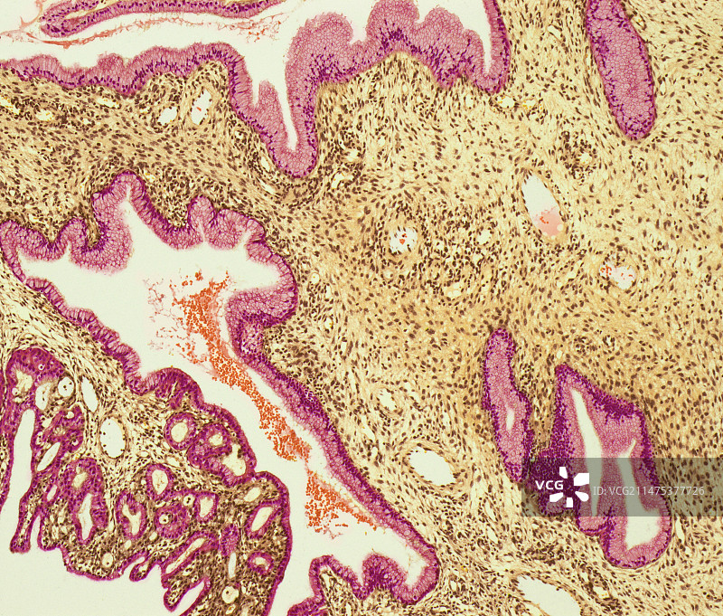 鼻息肉，光学显微照片图片素材