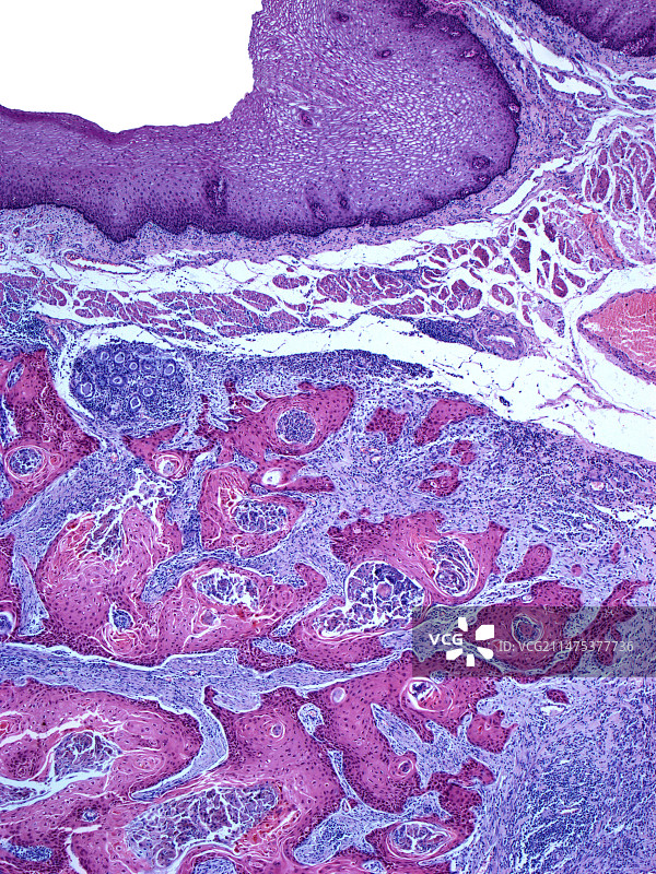 食道癌光显微照片图片素材