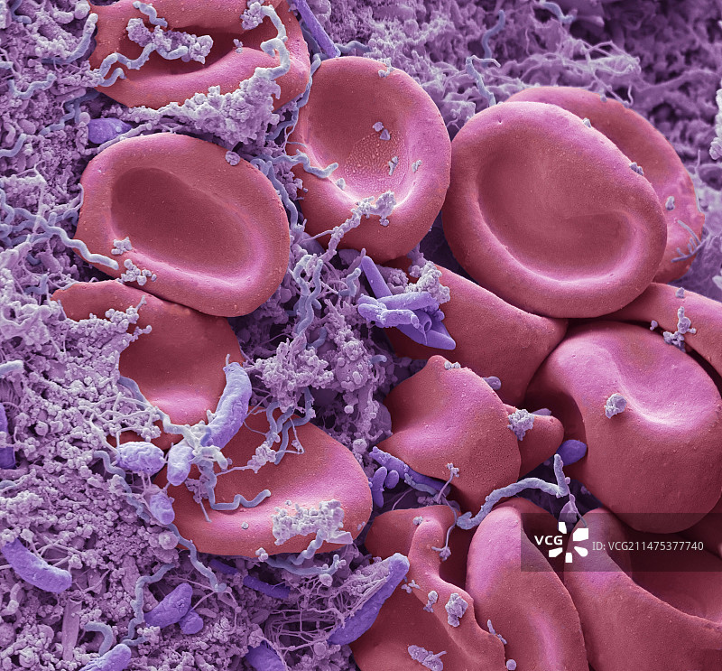 牙龈出血，扫描电镜图图片素材