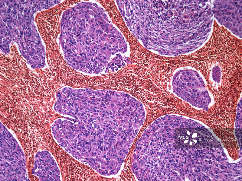 宫颈癌显微照片图片素材