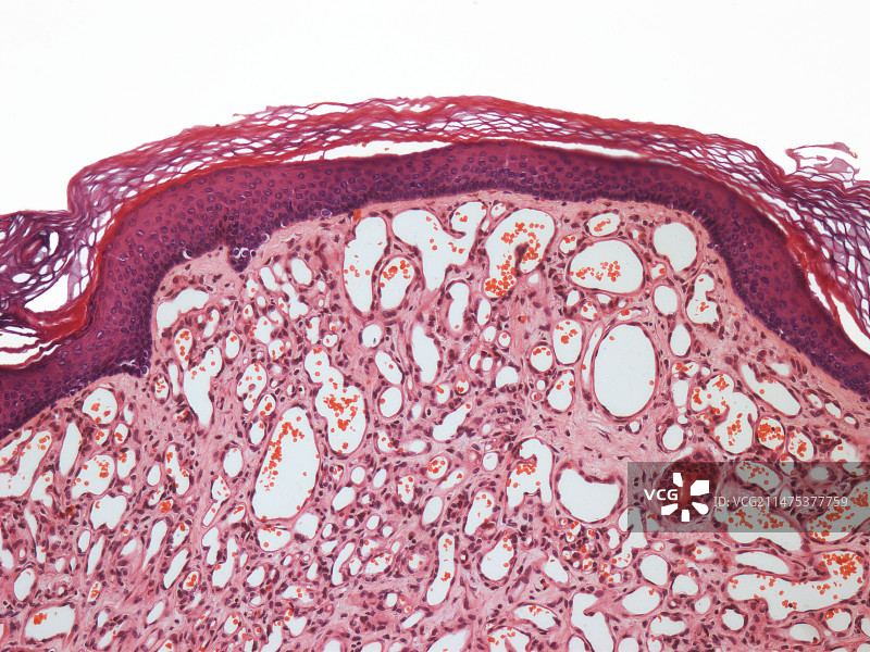 毛细血管瘤光学显微照片图片素材