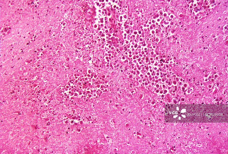 福氏耐格里阿米巴变形虫感染浅显显微照片图片素材