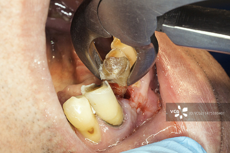 龋坏下门牙拔除图片素材