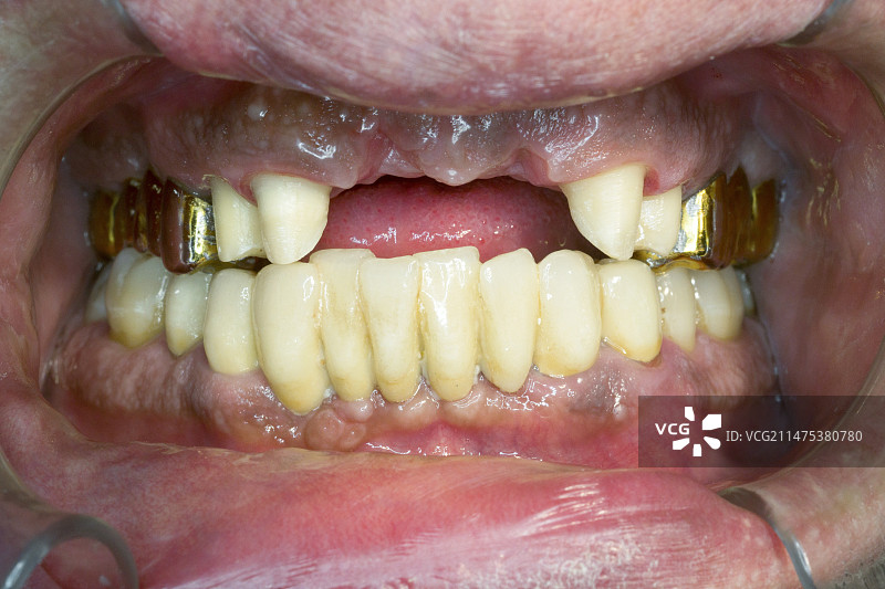 牙桥预备图片素材