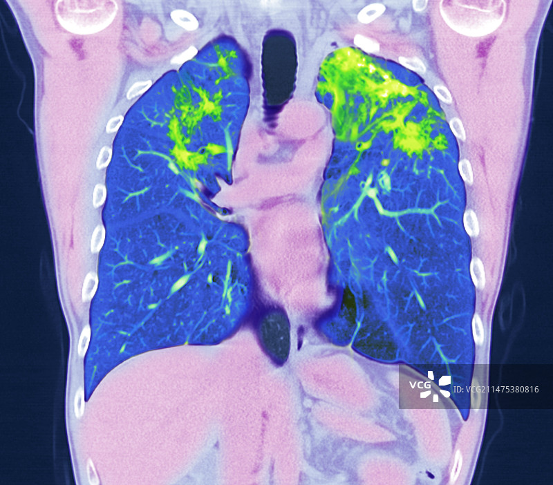 肺结节病CT扫描图片素材