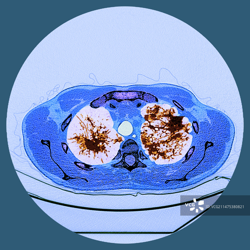 肺结节病CT扫描图片素材