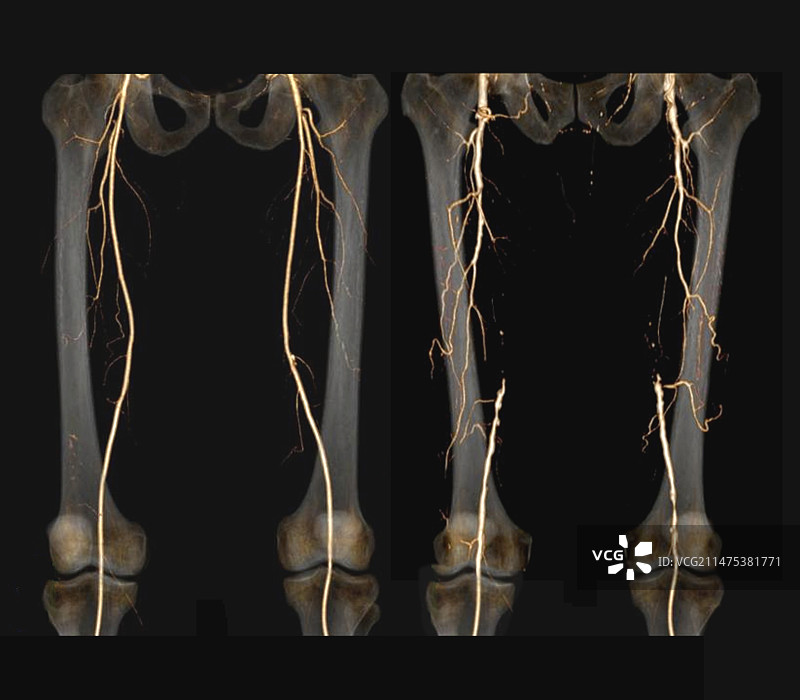 股动脉炎的影响：3D CT血管造影图片素材