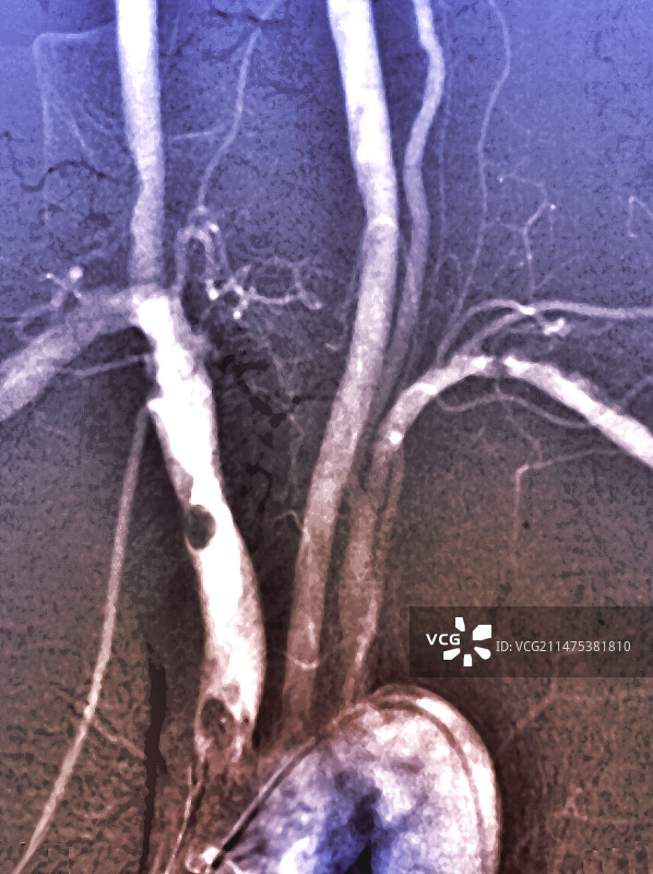 头臂动脉粥样瘤血管造影图片素材