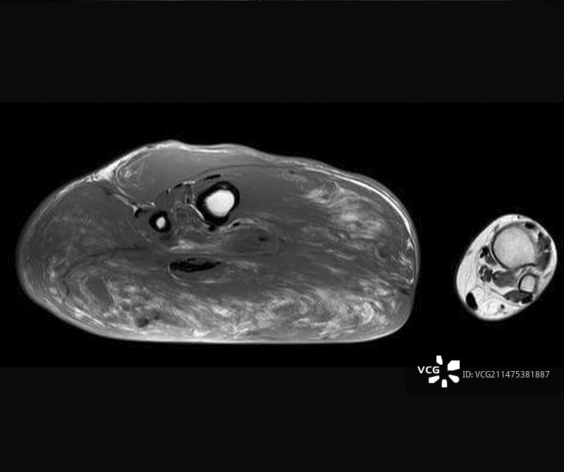腿部象皮病的轴向MRI扫描图片素材