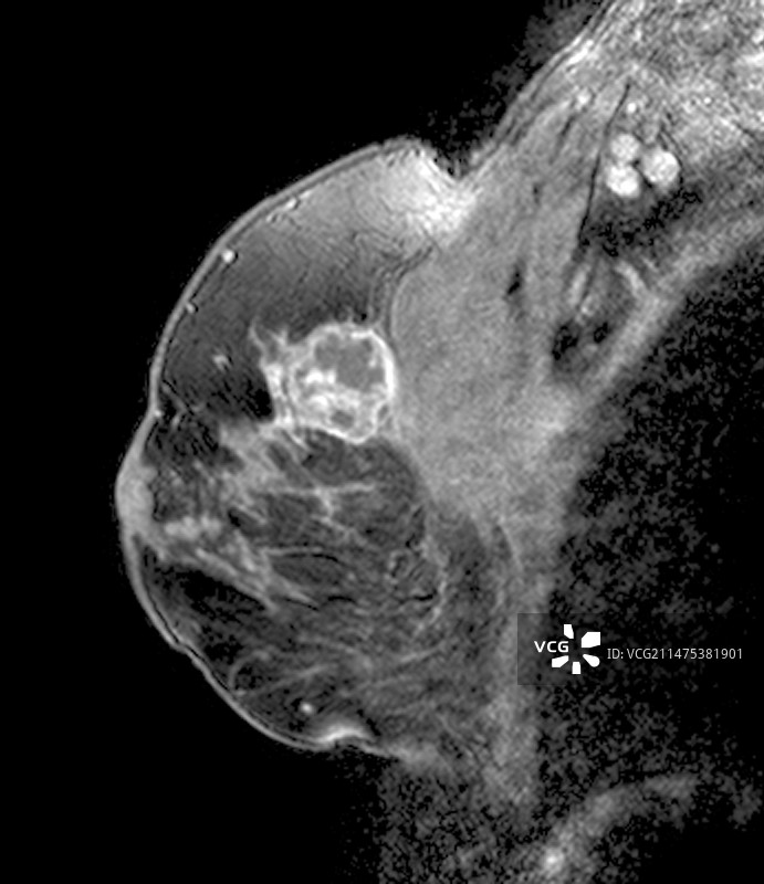 乳腺肿瘤矢状位MRI扫描图片素材