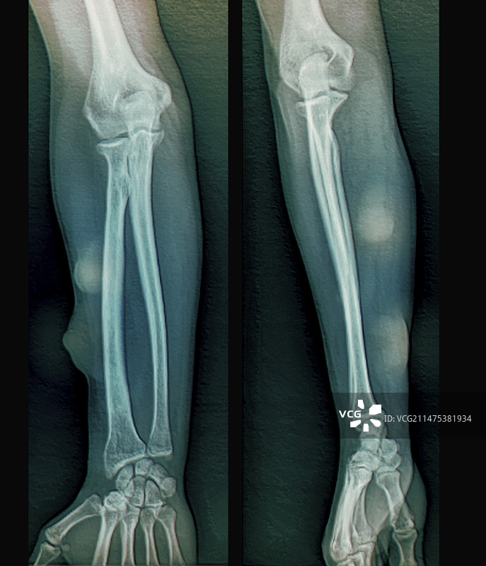 手臂上的皮下脂肪瘤X光片图片素材