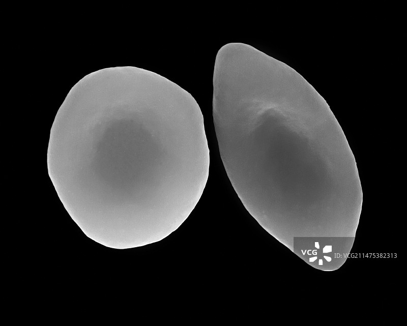 镰状细胞和正常红细胞扫描电镜图图片素材
