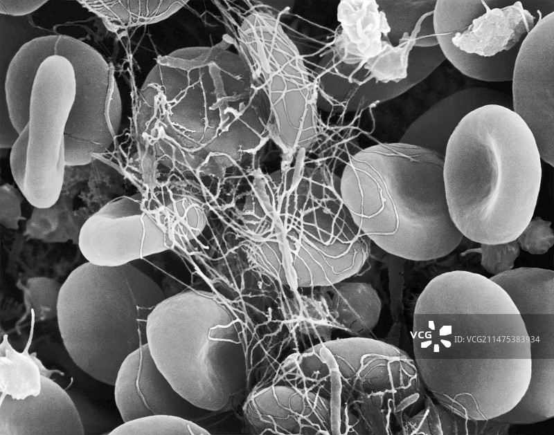 血纤维蛋白凝块中捕获的红细胞，扫描电镜图片素材