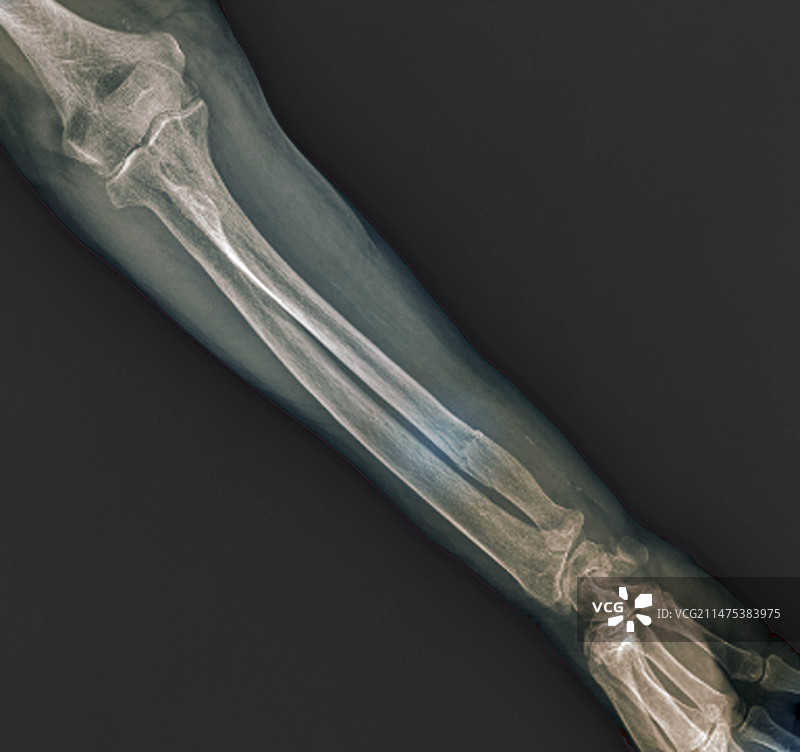 尺骨骨折X光片图片素材