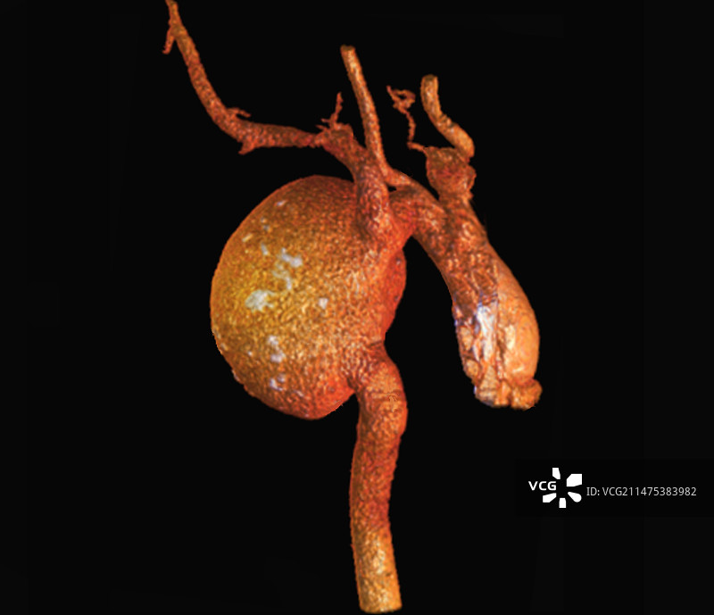 主动脉瘤3D CT扫描图片素材