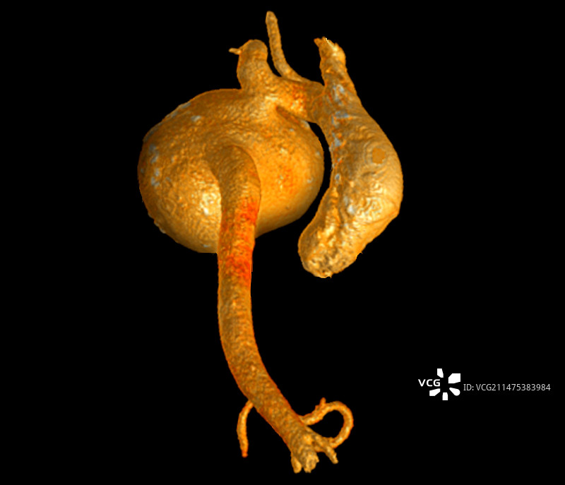 主动脉瘤3D CT扫描图片素材