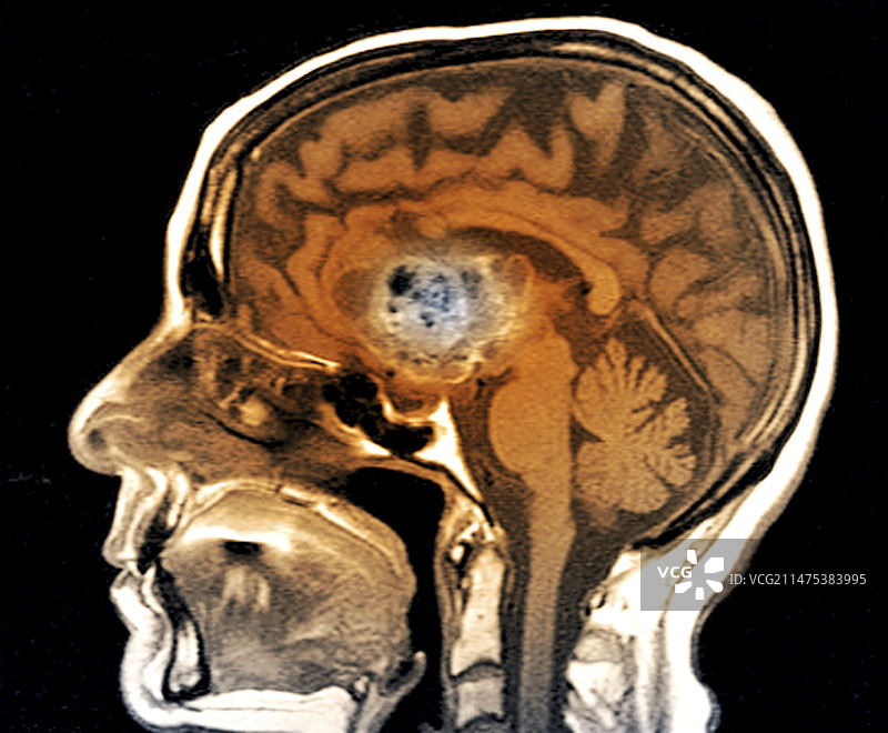 星形细胞瘤脑癌核磁共振扫描图片素材