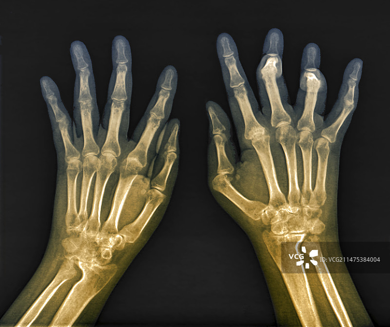 手部类风湿性关节炎X光片图片素材