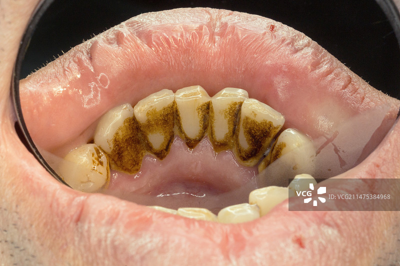 牙结石图片素材