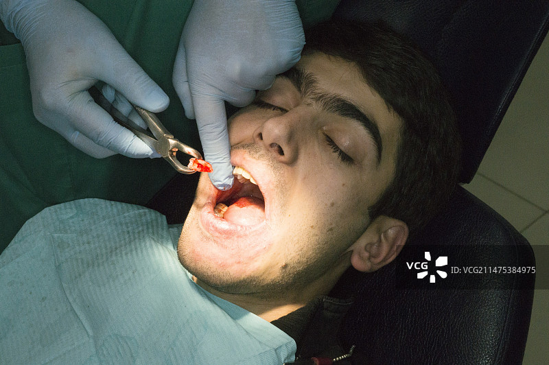 拔智齿图片素材