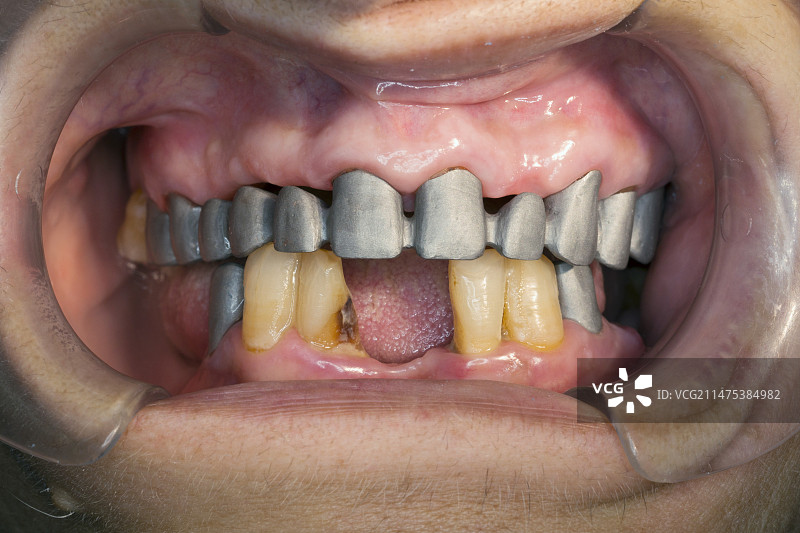 牙桥预备图片素材