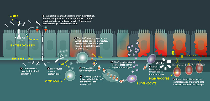 乳糜泻疾病机制图图片素材