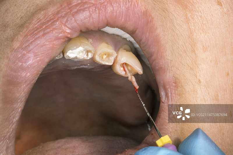 根管手术图片素材