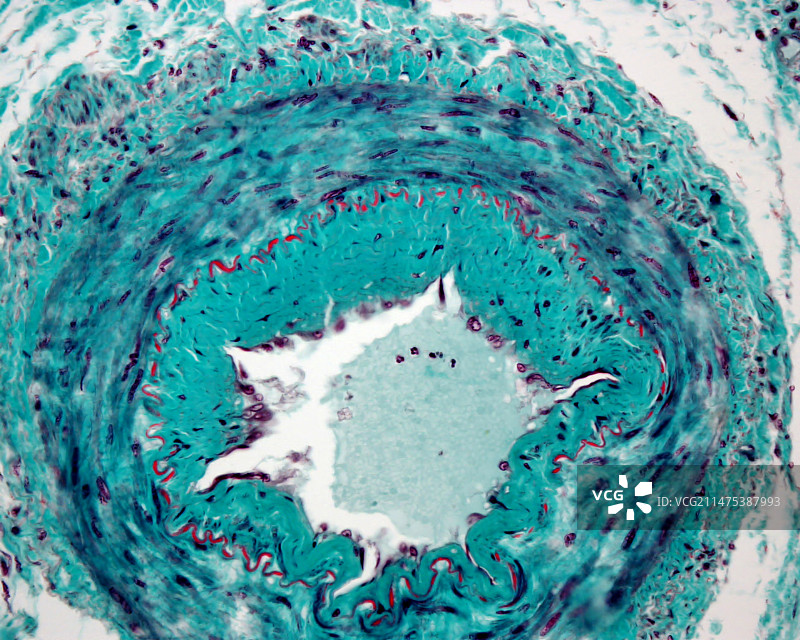 患病的肌肉动脉，光学显微照片图片素材