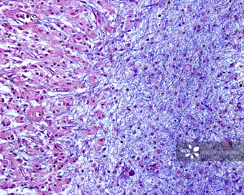 松果体神经胶质疤痕显微照片图片素材